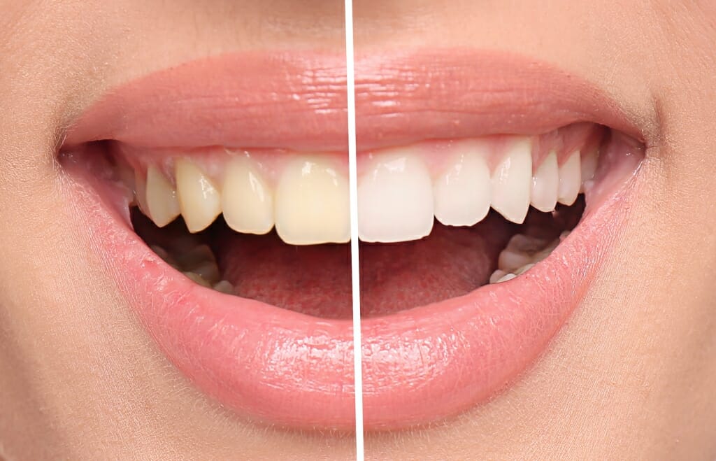 Zoom Whitening Before & After